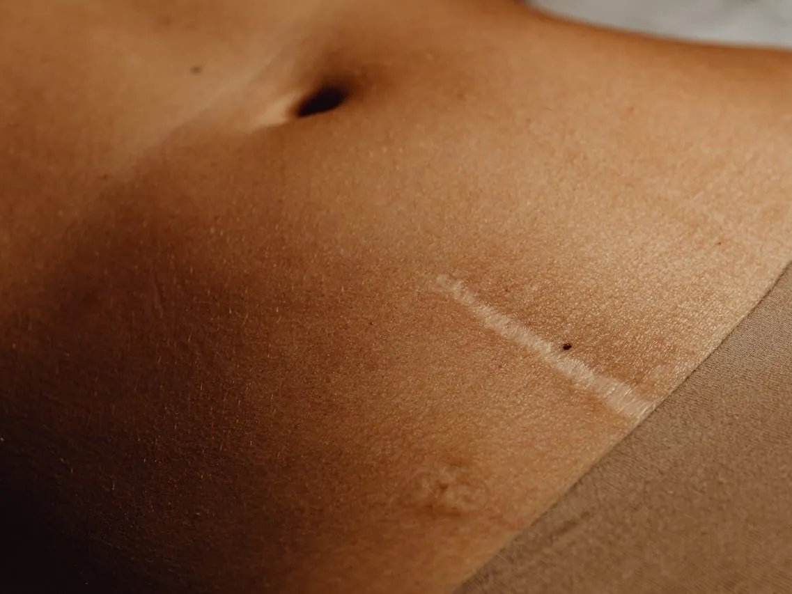 Narbe am Bauch nach einer Operation